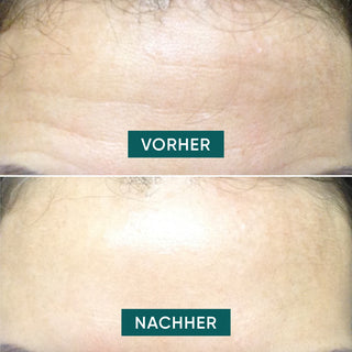 Wiederverwendbares Stirn Pad "Fantastic Forehead"